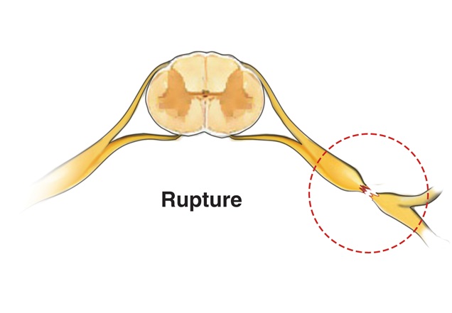 Illustration of a brachial plexus injury caused by a nerve rupture.
