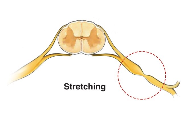 Illustration of a brachial plexus injury caused by a stretched nerve.