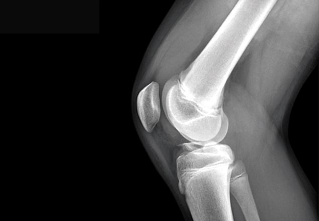 xray of injury to the knee growth plate