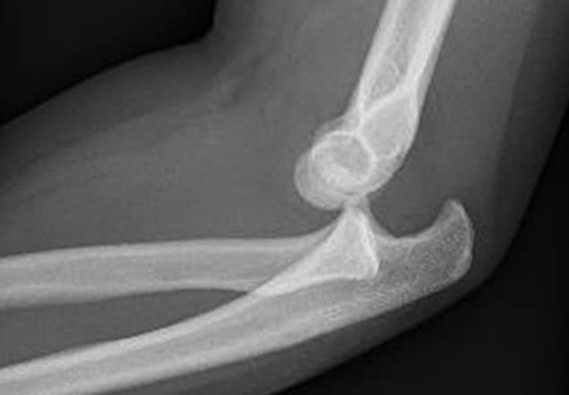 elbow dislocation x-ray