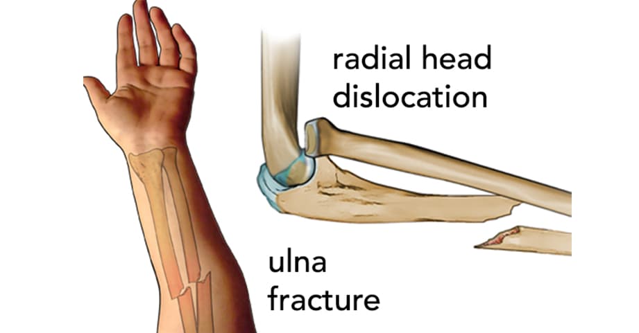 forearm fracture diagram