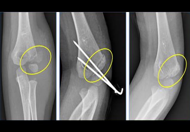 lateral condyle elbow fracture