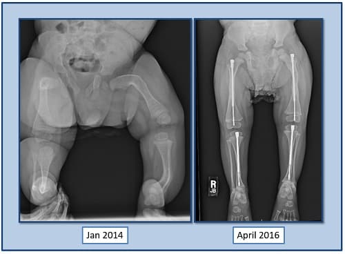 before and after X-rays of a child with OI