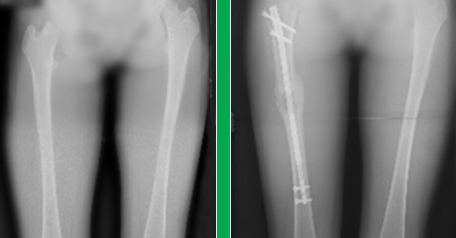 X-ray image of an internal lengthening nail procedure before and after