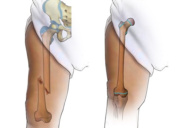 Femur fracture repair illustration 