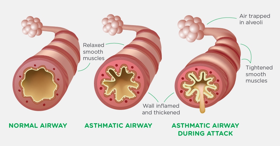 This illustration shows what happens during an asthma attack or flare-up.