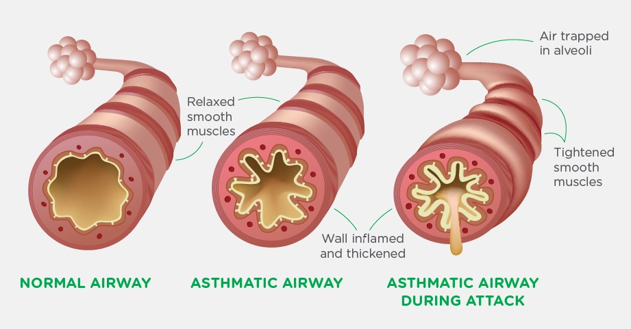 literature review on asthma attacks