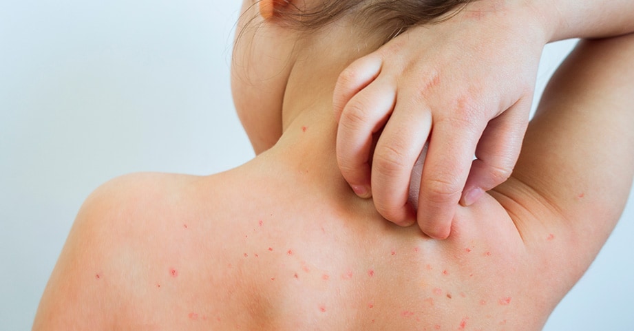 Small child with back rash