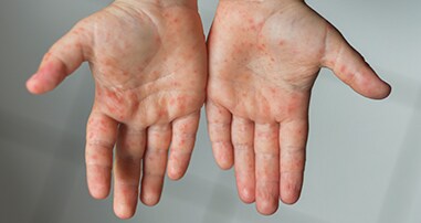 Measles rash on a child's hands