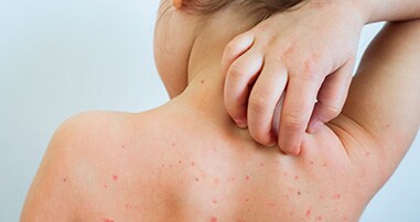 Small child with back rash