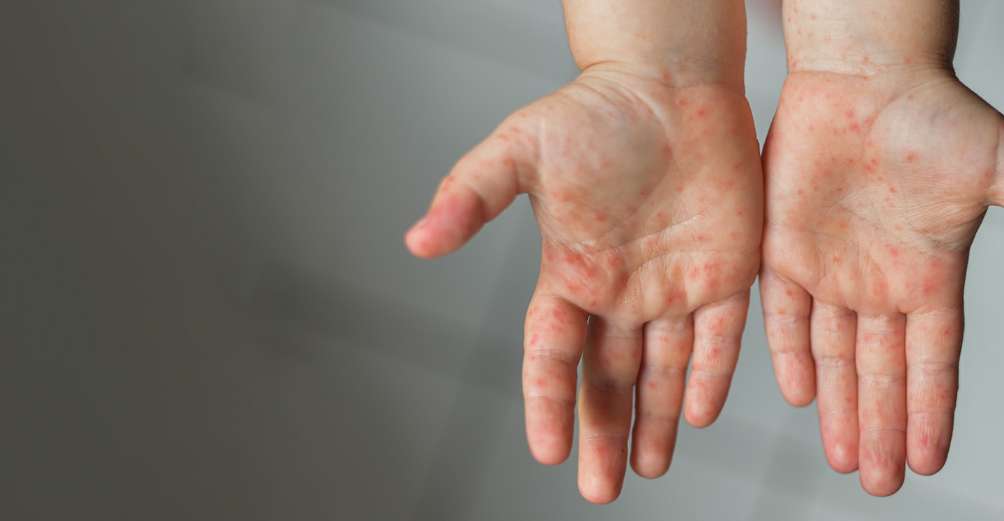 Measles rash on a child's hands
