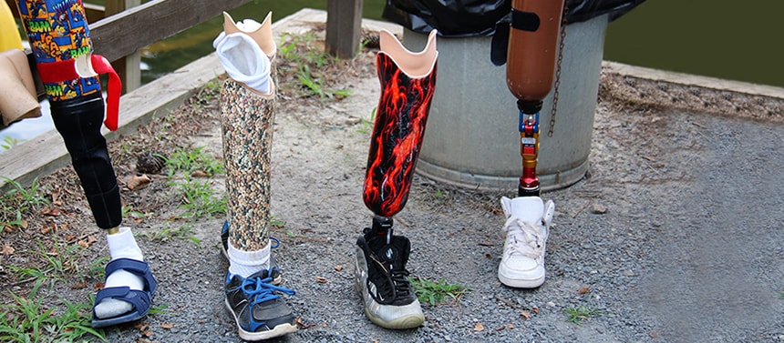 Prosthetics at summer camp for pediatric limb deficiency and amputations