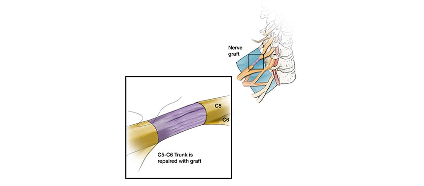 Illustration shows surgical removal of a healthy nerve to replair a damaged nerve for a brachial plexus injury.