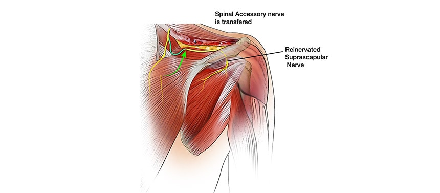 Illustration shows healthy spinal accessory nver used to repair the damaged suprascapular nerve during brachial plexus surgery.