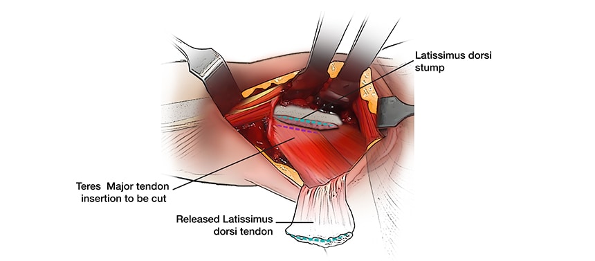 Illustration shows muscles to be transferred during a tendon transfer to repair a brachial plexus injury.