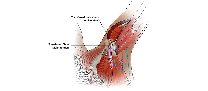Illustrations shows the transferred tendon that will help the arm move after a surgery to repair a brachial plexus injury. 