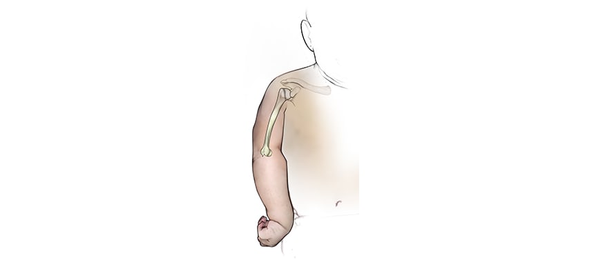Illustration shows the upper arm bone that is cut and moved into correct position during a humeral osteotomy to repair a brachial  plexus injury.