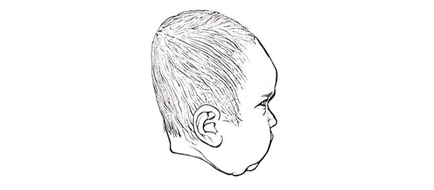 Sketch of the side of a child’s head; head appears to come to a point at the crown of the head