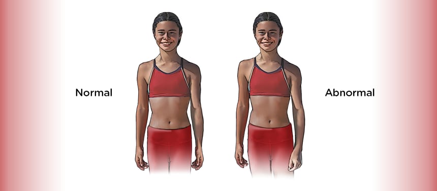 Scoliosis standing screening graphic