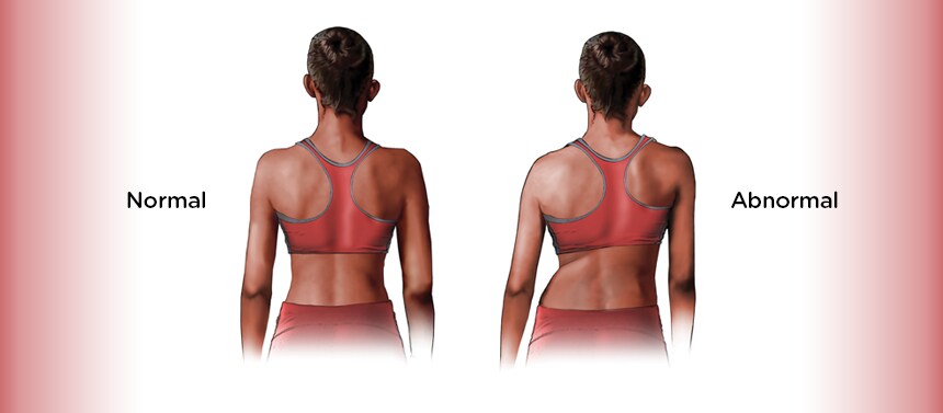 posterior standing scoliosis screening graphic