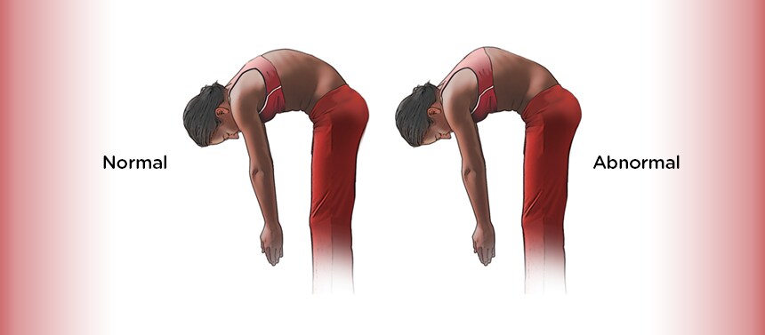side view bending over scoliosis screening graphic