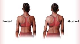 Side-by-side illustrations highlighting uneven shoulders and hips, a common sign of scoliosis. 