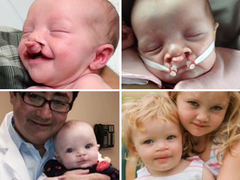 Pediatric Craniofacial Disorders | Children's Healthcare of Atlanta
