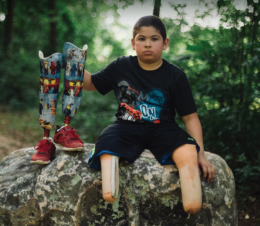 boy shows his prosthetic limbs